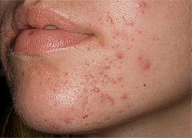 проблемная кожа лица - прыщи, угри, воспаления: лечиться механической чисткой лица